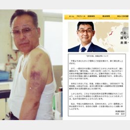 中村氏の左腕に残る痛々しいアザ（左・提供写真）、河井氏の公式ＨＰから削除された抗議文