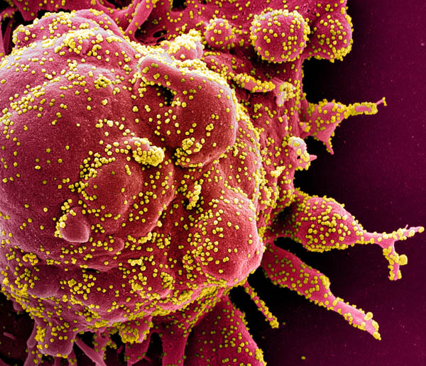 どんどん変異していく…（SARS-COV-2ウイルスのかけら≪黄≫に染まるアポトーシス細胞≪赤≫の電子顕微鏡写真）／（Ｃ）ロイター