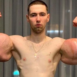 超人ハルクに憧れた男の悲劇…ワセリン注入で腕切断の危機