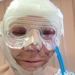 3年間まぶたが閉じません！ 79歳男性が美容整形失敗、寝る時は目をテープで…