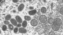 奇病ウイルス「サル痘」が世界12カ国へ謎の感染拡大…“夏のワンナイトラブ”にご用心！
