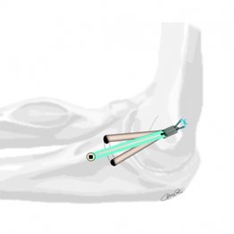京都府立医大で実施しているハイブリッド手術のイラスト（茶色が移植靭帯、真ん中の緑色が人工靭帯）／（写真提供）京都府立医科大学