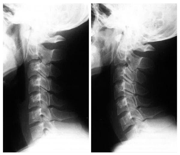 治療後（右）は治療前（左）に比べて首のカーブが復活（提供写真）