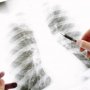 気象予報士・森田正光氏は胸腔鏡手術で回復へ…喫煙と関係ないタイプの「肺がん」はX線で見つかりやすい