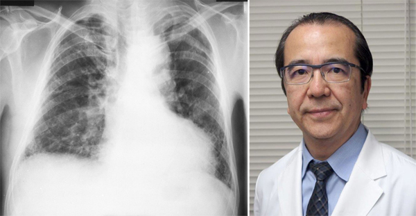 東邦大学医療センター・本間栄教授（写真右）と肺のレントゲン写真／（提供写真）