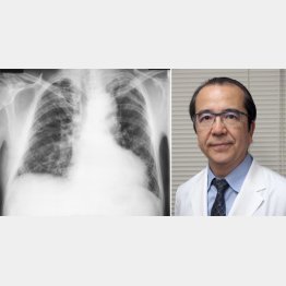東邦大学医療センター・本間栄教授（写真右）と肺のレントゲン写真／（提供写真）