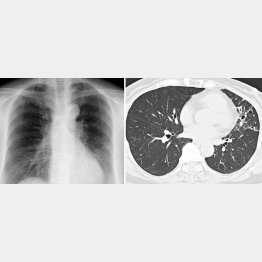 50代女性。胸部X線写真（左）では見落とされやすいが、CT（右）では明らか（徳田医師提供）