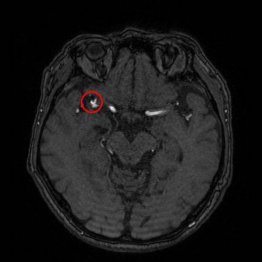 EIRL Brain Aneurysm（エイル・ブレイン・アニュリズム）検出画面（エルピクセル提供）