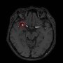 「脳動脈瘤」をスクリーニングするAI画像診断支援ソフトの威力