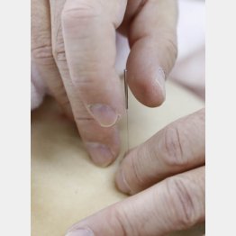 日本式の「痛くない鍼」が世界の主流になりつつある（Ｃ）日刊ゲンダイ